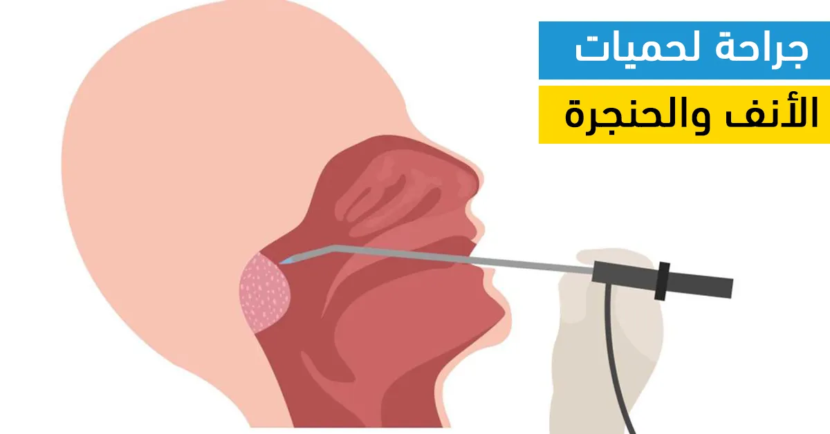 جراحة لحمات الأنف والحنجرة